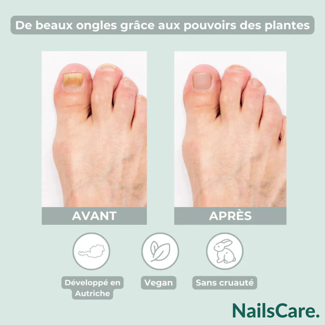 NailsCare pen- Fini mycoses des ongles