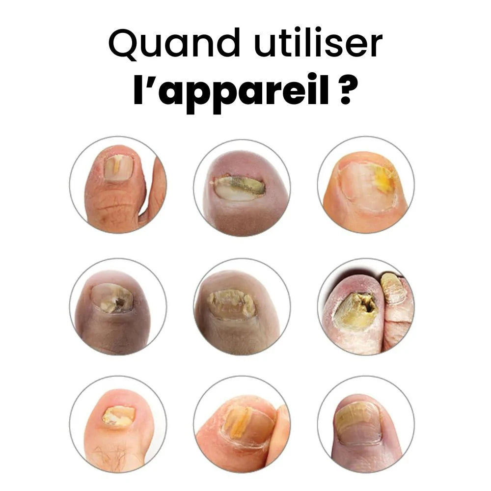 Appareil traitement des mycoses