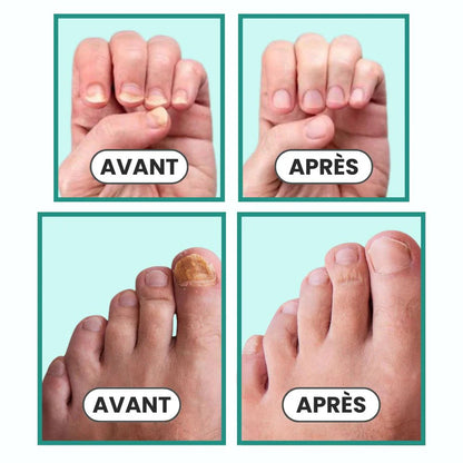 Appareil traitement des mycoses