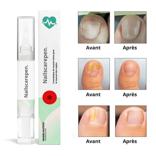 NailsCare pen- Fini mycoses des ongles
